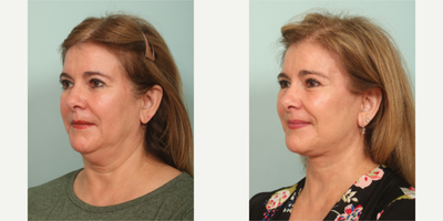65-74 year old woman treated with Mini Facelift, Neck Lift - performed by Dr.Sozer