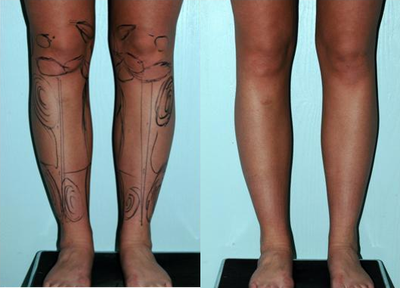 Calve and Ankle Liposculpture - Patient with thick calves and ankles and  ( also lipo fullness of hips and thighs and knees done as well). Results after treating  calves, knees, and ankles with finesse microcannula liposculpture under general anesthesia.