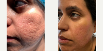 Woman treated with Facial - Acne treated with lasers and fillers