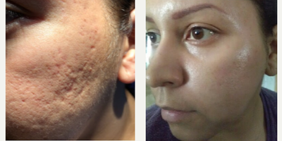 Woman treated with Facial - Acne treated with lasers and fillers