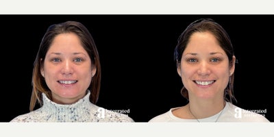 35-44 year old woman treated with Dysport - The patient is a 38-year-old female who had concerns about fine lines and wrinkles on her upper face. Dr. Chiang used wrinkle relaxer (Dysport) to treat the forehead, glabella, crows feet, and lower brows to address these concerns. The after results are 2 weeks post-treatment.