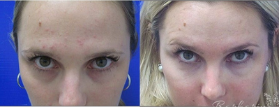 Woman treated with Liquid Facelift - This patient had severe hollowing in the under eye area. Dr. Barbarino injected her tear troughs with Belotero to restore a more rested and youthful appearance.