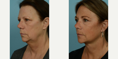55-64 year old woman treated with Facelift, Lower Facelift, Neck Lift, Laser Resurfacing, Dermabrasion - At age 62, this patient sought to make her outward appearance better reflect her active and vibrant lifestyle. After having her primary facelift over a decade ago, she decided to pursue another procedure, opting for a secondary deep plane facelift, along with perioral fat grafting and ablative laser with spot dermabrasion around her mouth. She selected 'Facelift/Minilift by Dr. Mustoe in Chicago' due to his expertise and innovative approach to these techniques. The patient wanted to tighten her neck and soften deep wrinkles and lines, aiming for a more youthful look which is compatible with her energetic outdoor activities and regular boating adventures.The procedures were meticulously carried out under local anesthesia and oral sedation in Dr. Mustoe's office, negating the need for drains, a testament to his innovative technique. This patient's zest for life was reflected in her quick recovery, as she was back socializing with her friends effortlessly just four days post-procedure. She reported finding the recovery process smooth and easy, and is delighted with her refreshed and rejuvenated appearance.