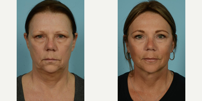 55-64 year old woman treated with Facelift, Lower Facelift, Neck Lift, Laser Resurfacing, Dermabrasion - At age 62, this patient sought to make her outward appearance better reflect her active and vibrant lifestyle. After having her primary facelift over a decade ago, she decided to pursue another procedure, opting for a secondary deep plane facelift, along with perioral fat grafting and ablative laser with spot dermabrasion around her mouth. She selected 'Facelift/Minilift by Dr. Mustoe in Chicago' due to his expertise and innovative approach to these techniques. The patient wanted to tighten her neck and soften deep wrinkles and lines, aiming for a more youthful look which is compatible with her energetic outdoor activities and regular boating adventures.The procedures were meticulously carried out under local anesthesia and oral sedation in Dr. Mustoe's office, negating the need for drains, a testament to his innovative technique. This patient's zest for life was reflected in her quick recovery, as she was back socializing with her friends effortlessly just four days post-procedure. She reported finding the recovery process smooth and easy, and is delighted with her refreshed and rejuvenated appearance.