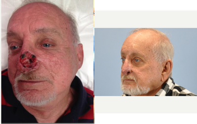 68 year old treated with median forehead flap - This patient underwent a two-stage median forehead flap nose reconstruction procedure due to facial skin cancer.