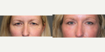 Brow, Upper Lid, Skin Rejuvenation - Brow, upper lid, skin rejuvenation with browlift, upper eyelid surgery and laser resurfacing.