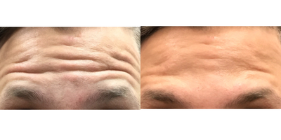 25-34 year old man treated with Botox - This young man was treated with botox. There really is an art to this process. The goal, in my eyes, is to soften areas of the face not to simply paralyze them.