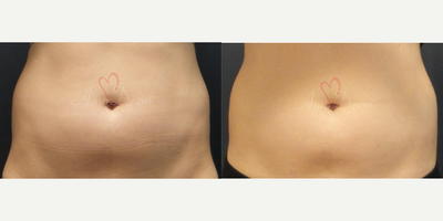 25-34 year old woman treated with SculpSure - Non-surgical removal of stubborn fat in belly and flanks with SculpSure (compare with CoolSculpting)
