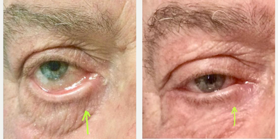 Man treated with Eyelid Retraction Repair, Eyelid Surgery - Man treated with Eyelid Retraction Repair, Eyelid Surgery