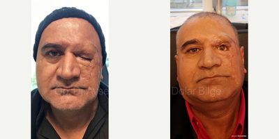 Man treated with Eyelid Surgery, Brow Lift, Prosthetic Eye - Man treated with Eyelid Surgery, Brow Lift, Prosthetic Eye