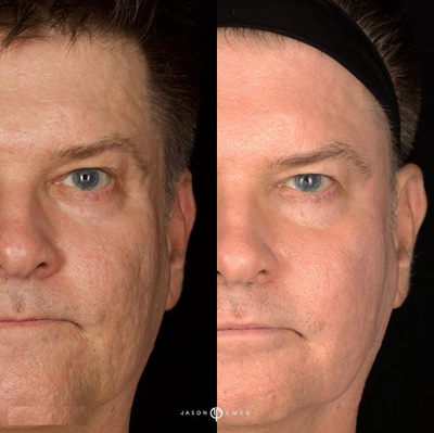Man treated with Morpheus8 - Man treated with Morpheus8