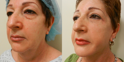 55-64 year old woman treated with Chin Liposuction - 55-64 year old woman treated with Chin and Face Liposuction, with Neck Lift with Platysmaplasty.