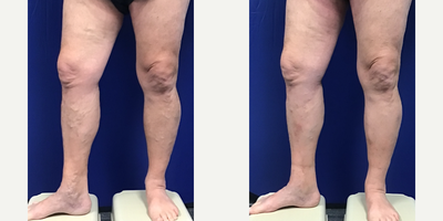 60 year old man treated with EVLT - 60 year old male vein patient treated with bi-lateral Endovenous Laser Ablations, followed by Ambulatory Phlebectomy to remove his many bulging veins.