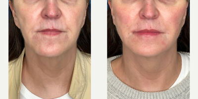 Patient treated with Endolift - Patient treated with Endolift