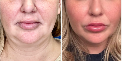 Patient treated with Endolift - Patient treated with Endolift