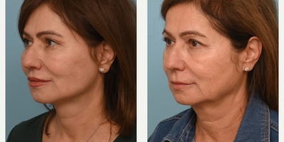 55-64 year old woman treated with Facelift - Dr. Balikians intention is to always to enhance an individuals existing beauty to create natural, long-lasting results. He did exactly that with his wonderful patient who is in her 60s and wanted a refreshed look.