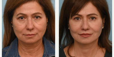 55-64 year old woman treated with Facelift - Dr. Balikians intention is to always to enhance an individuals existing beauty to create natural, long-lasting results. He did exactly that with his wonderful patient who is in her 60s and wanted a refreshed look.