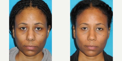 Woman treated with African American Rhinoplasty - Woman treated with African American Rhinoplasty