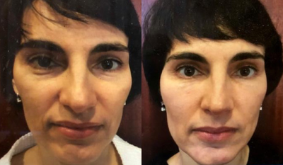 45-54 year old woman treated with SlimLipo - 45-year-old patient underwent Organic Facial Rejuvenation with fat transfer and PRP.