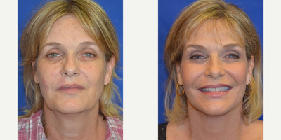 45-54 year old woman treated with Facial Fat Transfer - This patient came in wanting to improve her overall appearance. After consulting with Dr. Ho, the patient elected to have a face/neck lift to tighten the skin, fat grafting to restore lost volume and laser skin resurfacing to improve texture and tone.