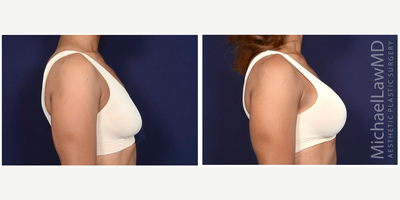 35-44 year old woman treated with Strattice - Augmentation mastopexy with Strattice. Follow-up photo taken 1 month after the procedure.