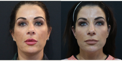 35-44 year old woman treated with Lip Augmentation - Obagi CRx to even skin tone, EndyMed to tighten, lip enhancement, plasma IQ to upper eyes and Botox.