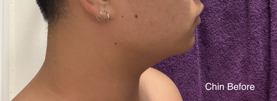 Jawline before (apparently he has removed more than 150g from below my chin only)