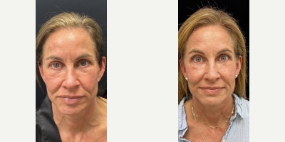 55 year old woman treated with Facial Fat Transfer - 55 year old woman treated with Facial Fat Transfer