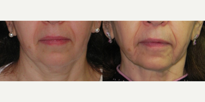 65-74 year old woman treated with ThermiTight - Frontal view of 65 year-old female with skin laxity in the neck. She underwent FaceTite /NeckTite subdermal radiofrequency skin tightening procedure. She is shown here 1 year after her procedure. Notice her crisp jawline and tighter neck tissues. Her next step is a Morpheus 8 to tighten her lower facial tissues. Normally these two procedures are performed on the same day but she wanted to stagger them on separate dates.