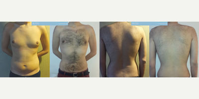 30 year old man treated with Vaser Liposuction - Dr. Ozge Ergun performed Vaser Liposuction & Gynecomastia, and this is the result of 59 days post operative.