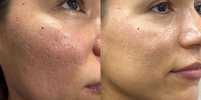 25-34 year old woman treated with Ellacor - This 30-year-old patient received Ellacor treatments to address acne scarring. In the before photo, taken on 4/21/2024, visible textural irregularities and redness from acne scarring can be seen on her cheeks. The after photo, taken on 6/3/2024, shows smoother, more even skin texture with a noticeable reduction in redness and scarring. Ellacor micro-coring technology effectively stimulates collagen production to restore skin smoothness, helping the patient achieve a refreshed and radiant complexion.