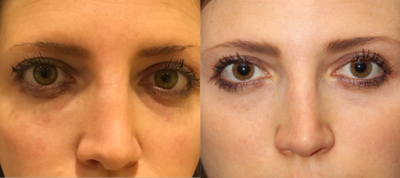 18-24 year old woman treated with Teosyal - This patient was treated with Teosyal's Redensity ll for under eye bags. 1 syringe was used to help reduce the look of puffiness under her eyes.