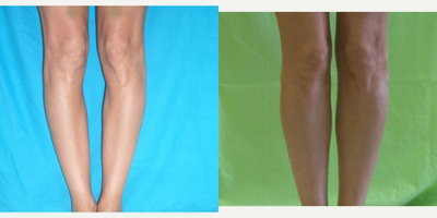 25-34 year old woman treated with Calf Implant - Calf Implants with additional fat injection