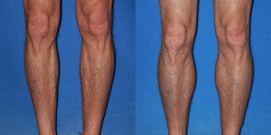 Calf Implant - 47 year old male now 4 months after calf implants, one medial and one lateral (2 implants in each leg).