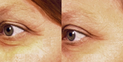 Woman treated with Pelleve - Woman treated with Pelleve