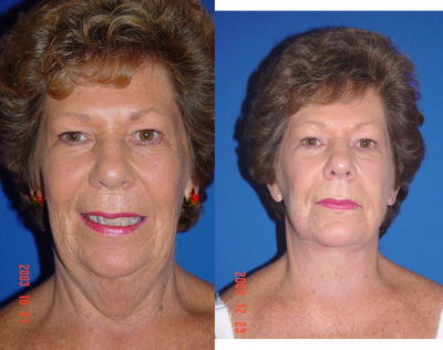 Facial Rejuvenation  - Facial Rejuvenation by Dr. Stefan&nbsp;