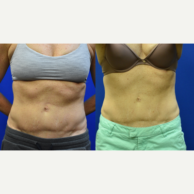 35-44 year old woman treated with Evolve - This patient had evolve trim, tite and tone on the abdomen. She previously had a tummy tuck with fat grafting. This provided with a great improvement of the appearance of her abdomen.