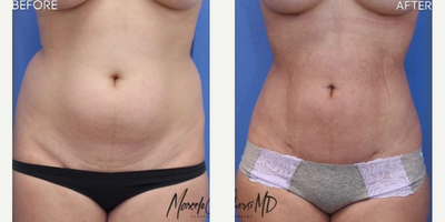 Woman treated with Abdominal Etching - Woman treated with Abdominal Etching as well as Liposculpture, shown 1 month post op.