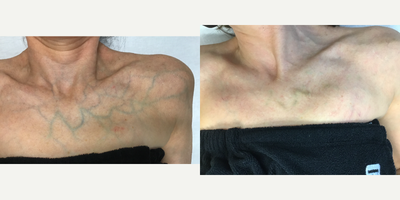 Female Treated with Sclerotherapy / Asclero for Prominent Chest Veins - Before & After 2 sessions of Sclerotherapy for chest veins! The vein will continue to heal and fade completely.