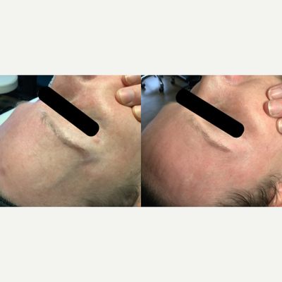 Female treated with Face Sclerotherapy - Before and after only 1 treatment of face sclerotherapy! Amazing results