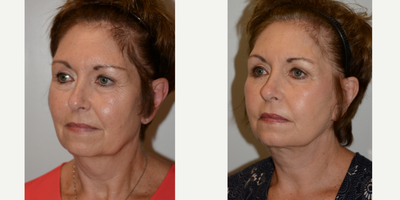 55-64 year old woman treated with Facelift - Facelift with Fat Transfer, Peri-Oral Erbium Laser, Lower Blepharoplasty