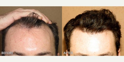 Man treated with Hair Transplant, ARTAS Robotic Hair Transplant - Man treated with Hair Transplant, ARTAS Robotic Hair Transplant
