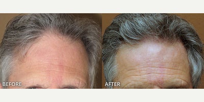 Man treated with Hair Transplant, ARTAS Robotic Hair Transplant - Man treated with Hair Transplant, ARTAS Robotic Hair Transplant