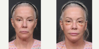 68-70 year old woman treated with Facelift Revision, Neck Lift Revision, Eyelid Surgery Revision, Facial Fat Transfer - Facelift RevisionNeck Lift RevisionLower Blepharoplasty RevisionFacial Fat Transfer