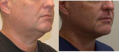 35-44 year old man treated with Chin Liposuction - jawline lipo