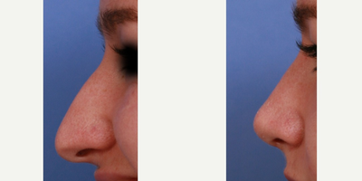 25-34 year old woman treated with Rhinoplasty for large nose, hump on bridge and downturned tip - Dr. Holden performed a rhinoplsty for this woman to address her large nose. The tip was downturned but pulled down further when she smiled. He reduced the size of her nose, removed the hump and rebuilt the tip of her nose. He elevated the tip slightly. With the support he placed, her nose did not pull down when she smiled.&nbsp;