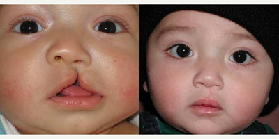 Cleft Lip Repair - Procedure is Cleft lip and nose repair. Unilateral cleft lip.