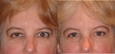 Ptosis repair and eyelid retraction surgery - This patient had ptosis (drooping) of the right upper eyelid and retraction of the left upper eyelid from thyroid eye disease. Surgery was performed in one session to raise the right upper eyelid and to lower the left upper eyelid.