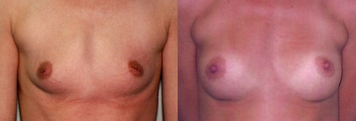 Breast Augmentation - 
	This 22 year old woman was unhappy with her 36 A breast size. She did not want very large breasts, just an increase to a large B/small C cup size. She had one child with no plans for any more. She underwent breast augmentation with 300cc Mentor Siltex round, high profile cohesive gel implants under the muscle.