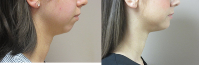 Chin Implant - Patient wanted to improve her profile with a chin implant.